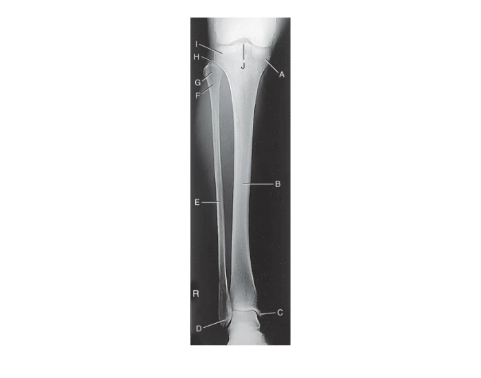 Radiograph -Tibia and Fibula AP labelling Quiz