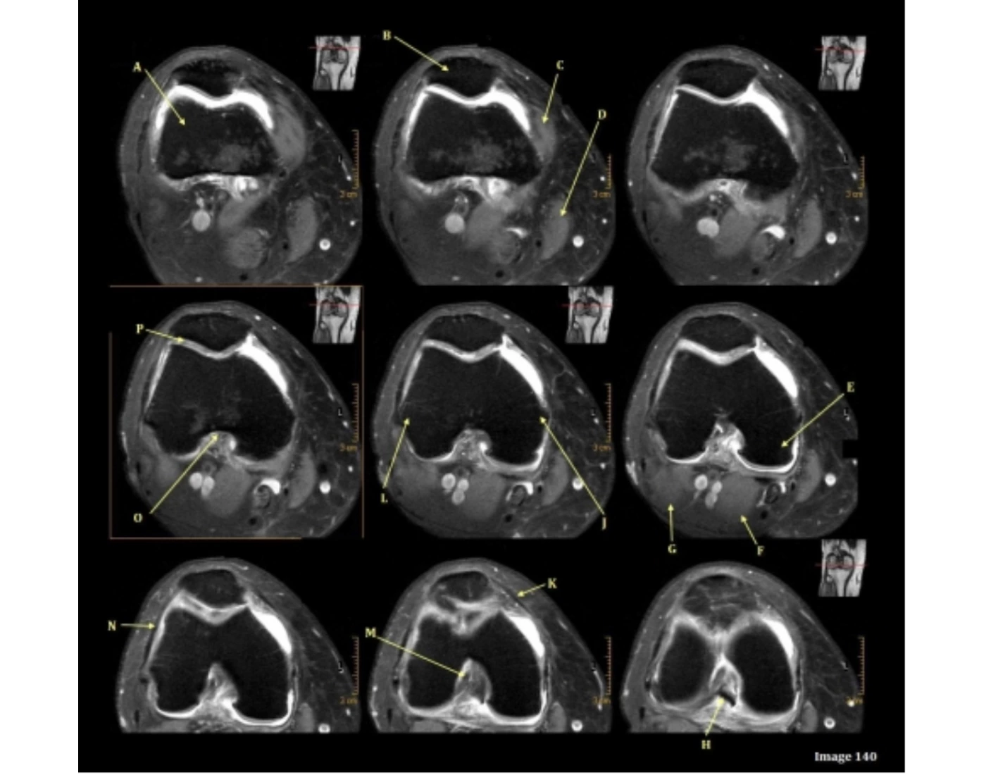 Knee MRI - MRIQUIZ #140 Quiz