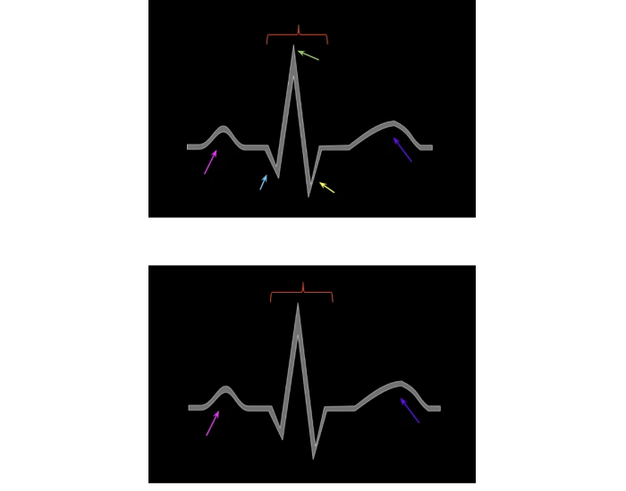 ECG PQRST Wave Quiz ecg-pqrst-wave-quiz