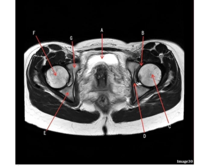 Bilateral Hip MRI MRIQUIZ 30 Quiz