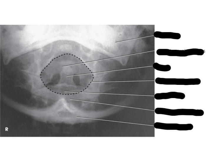 AP Atlas and Axis Fuchs Method Quiz