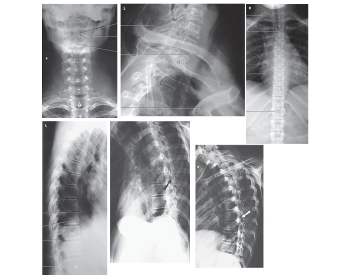 Spinal Projection T-Spine Projections Quiz