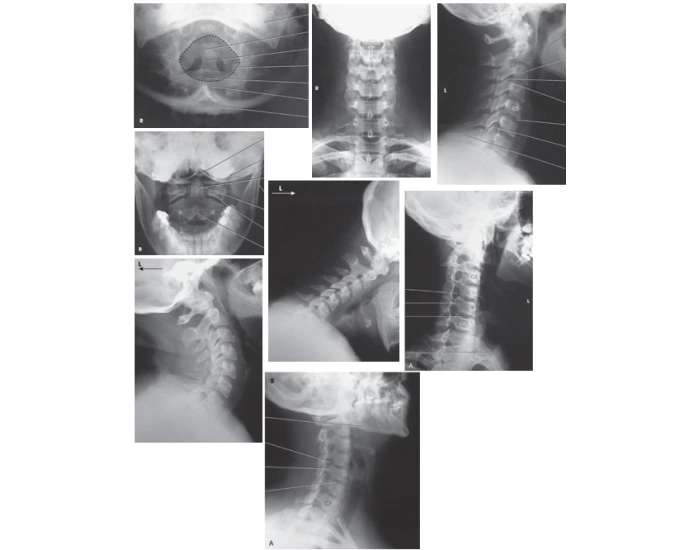 Spinal Projection Atlas, Axis and C-Spine Projections Quiz