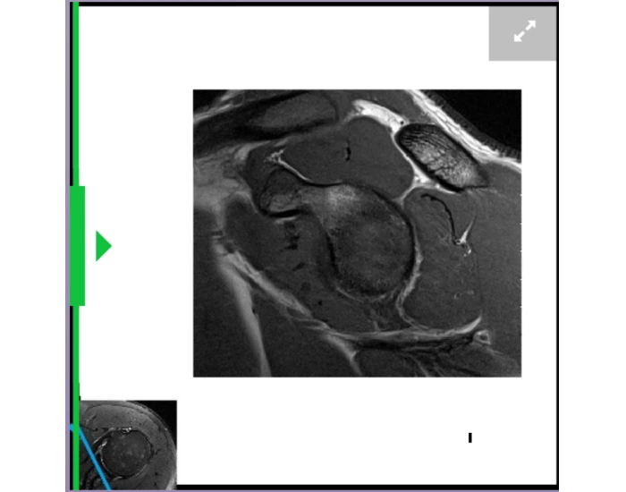 Rite Advantage- Sagittal Shoulder Quiz
