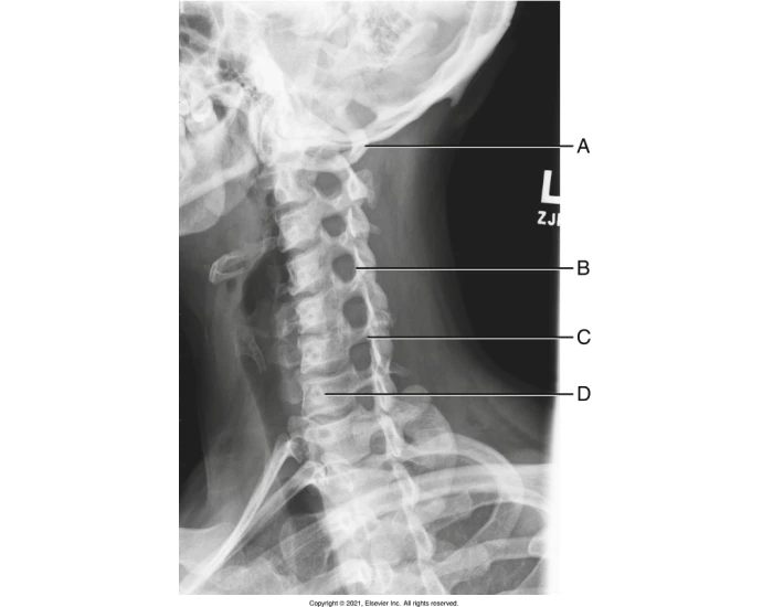 Xr Rpo View C-spine RPO X-ray Quiz