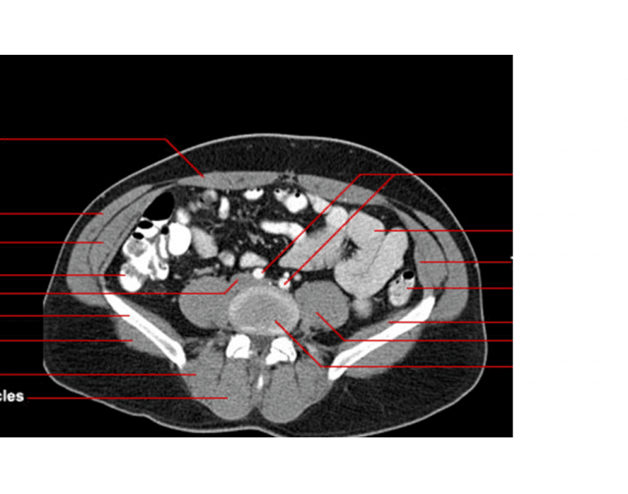 Abdomen Pelvis Axial CT 1 Quiz