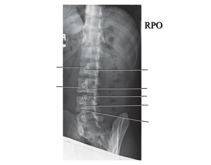 Obl Rd Pt OBL L-Spine Quiz