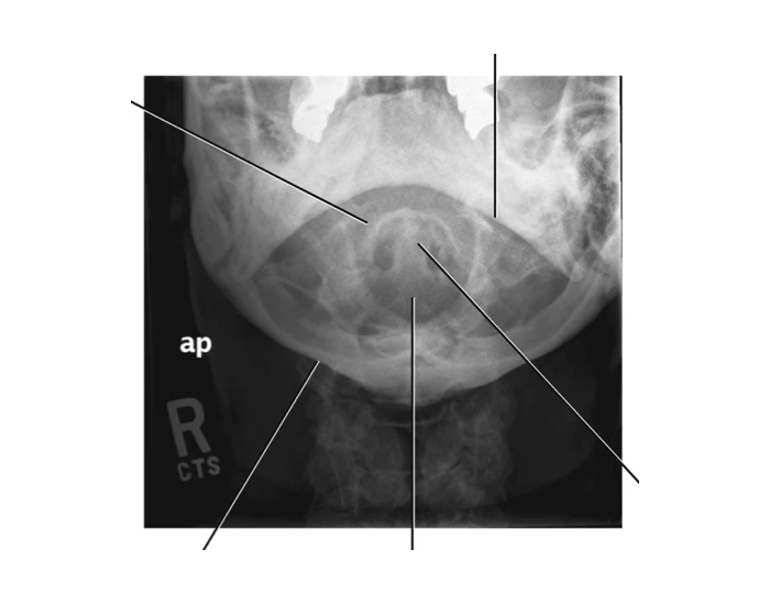 Ap odontoid fuchs method Quiz
