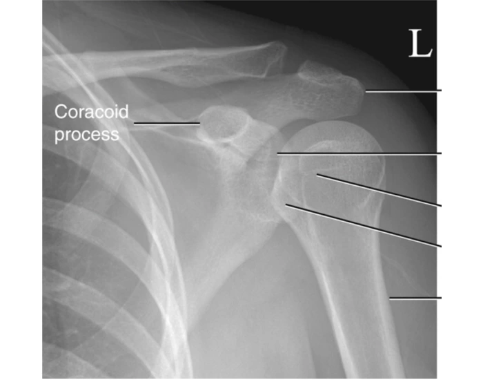internal rotation lateral humerus Quiz